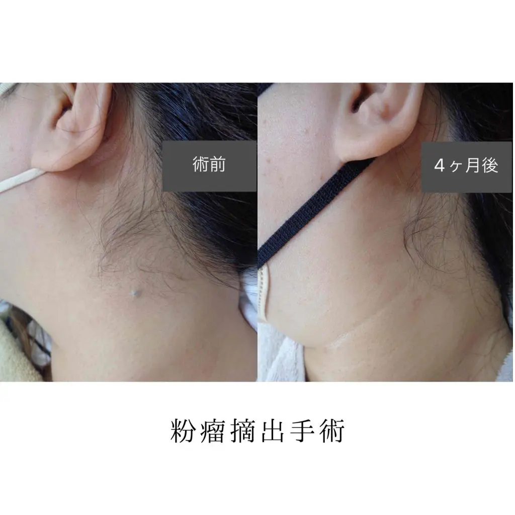 粉 瘤 手術 保険 おり る