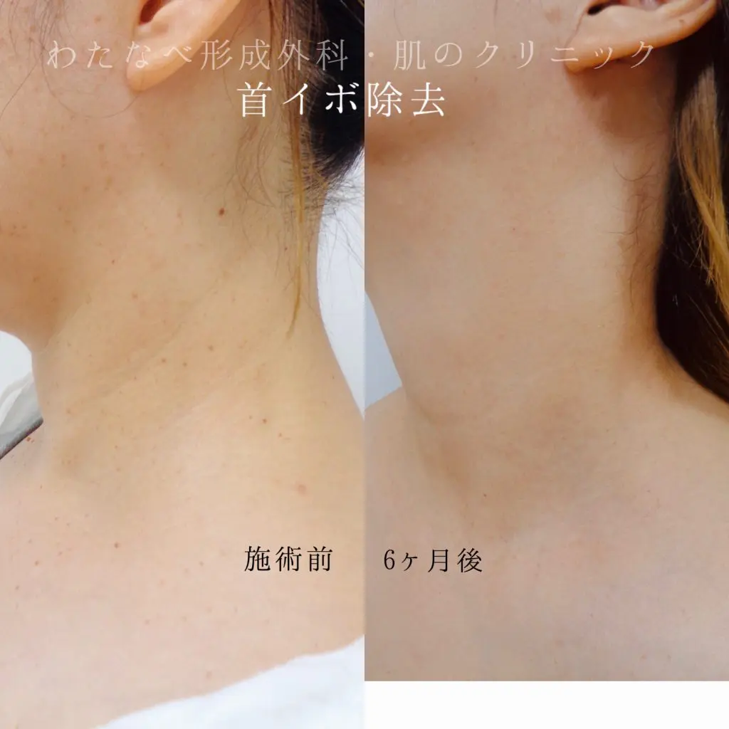 プロ仕様/エステ美容機/高周波/老人性イボ取りなど