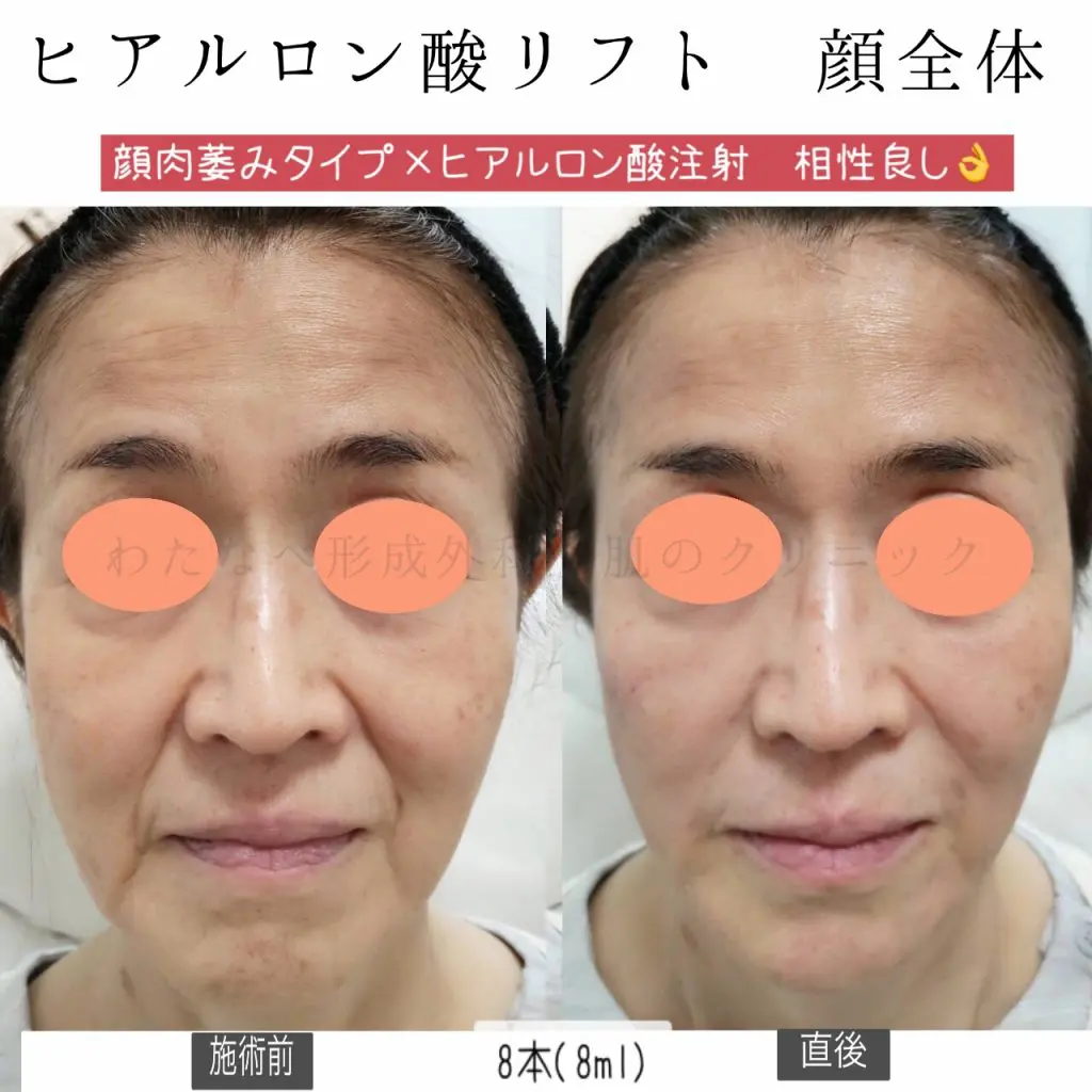 ヒアルロン酸注入 | 静岡駅｜わたなべ形成外科・肌のクリニック