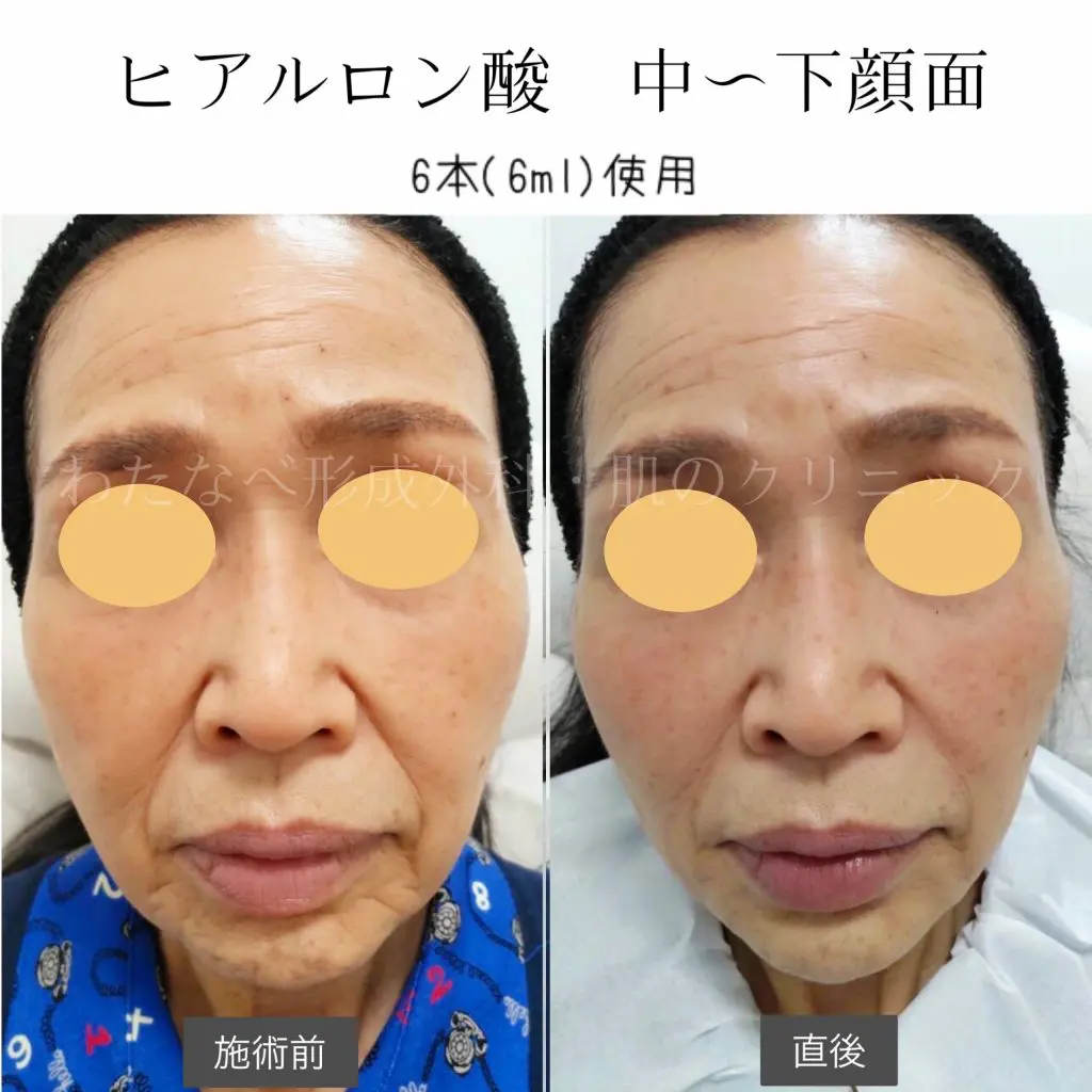 ヒアルロン酸注射【リフトアップ・シワ改善】 | 静岡駅