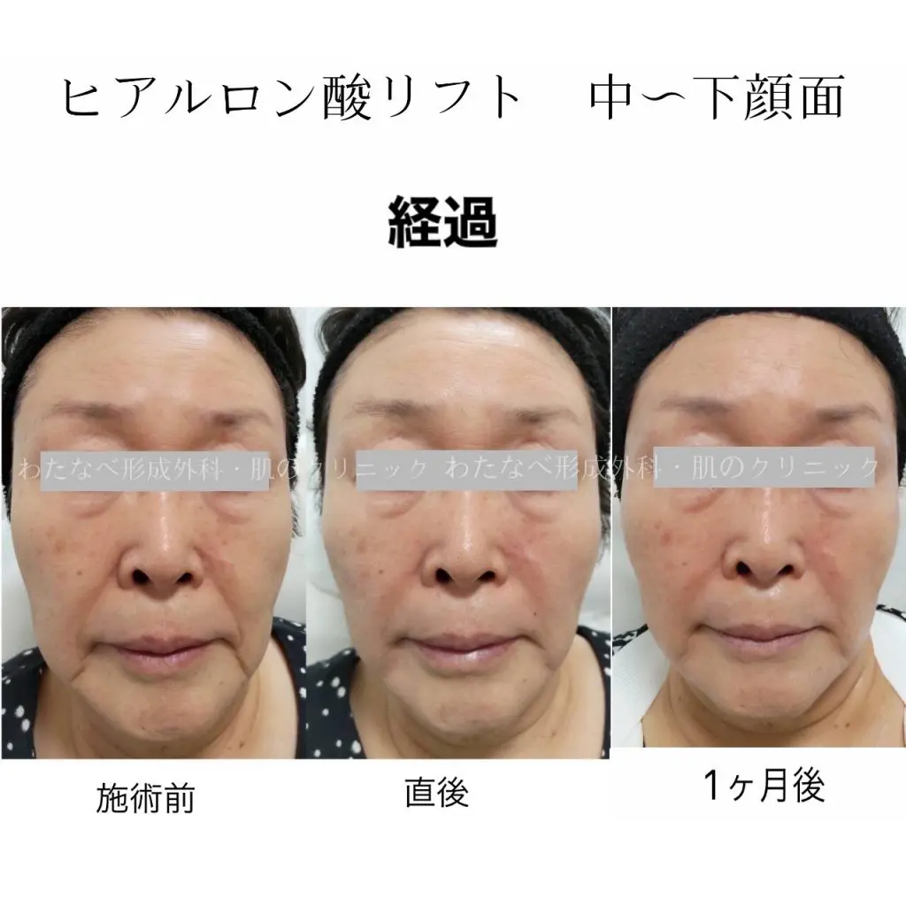 ヒアルロン酸注射【リフトアップ・シワ改善】 | 静岡駅