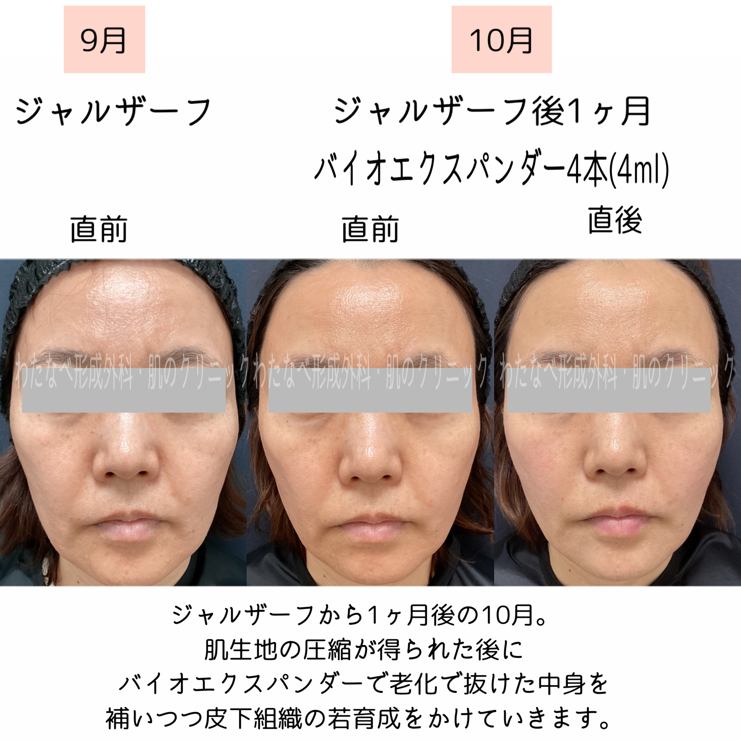 ザーフ（XERF) | 静岡駅｜わたなべ形成外科・肌のクリニック